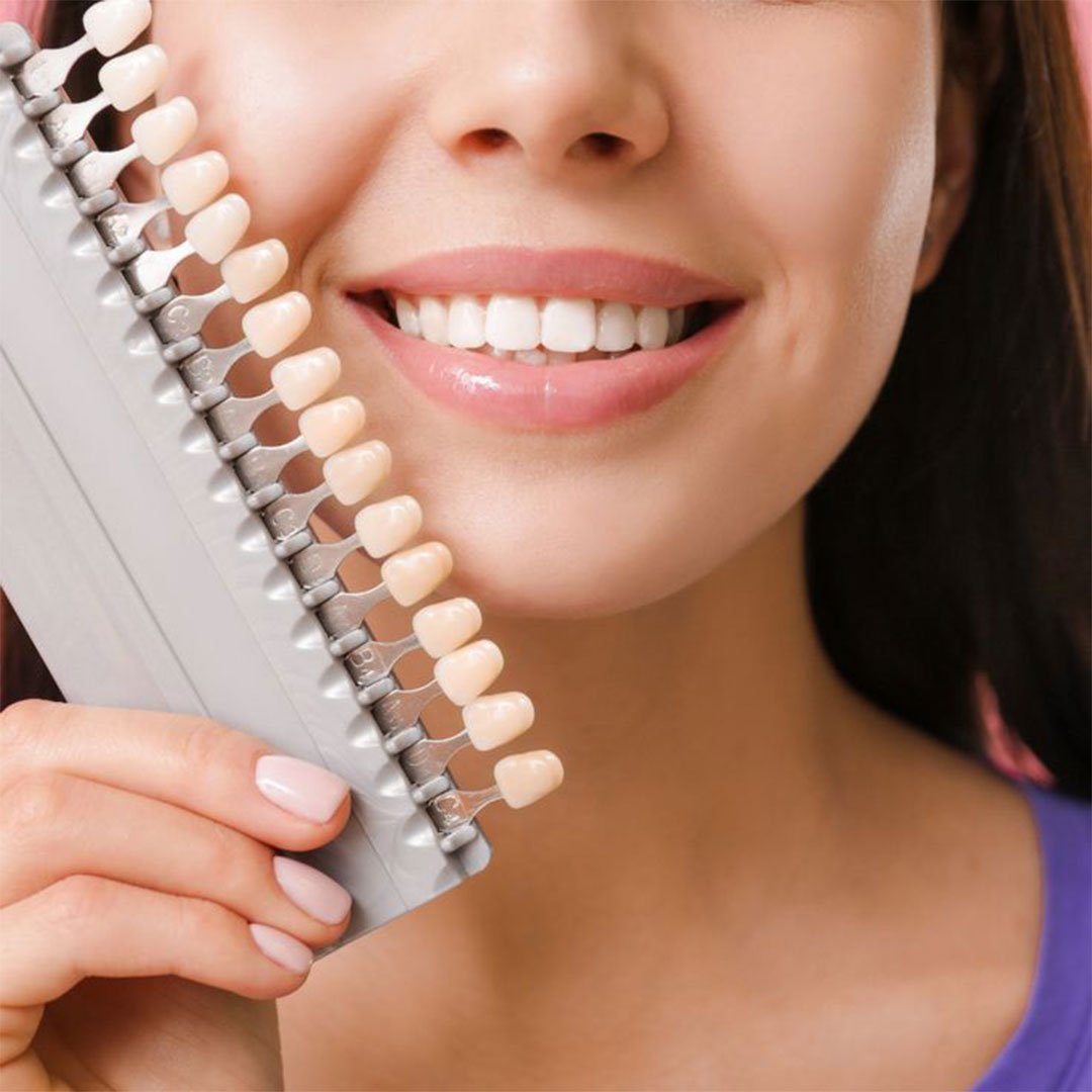 A beautiful smile makeover with porcelain veneers at a boutique Vista office.