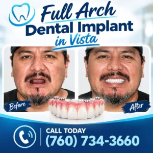 Full arch dental implants in Vista, California at Alta Vista Dental